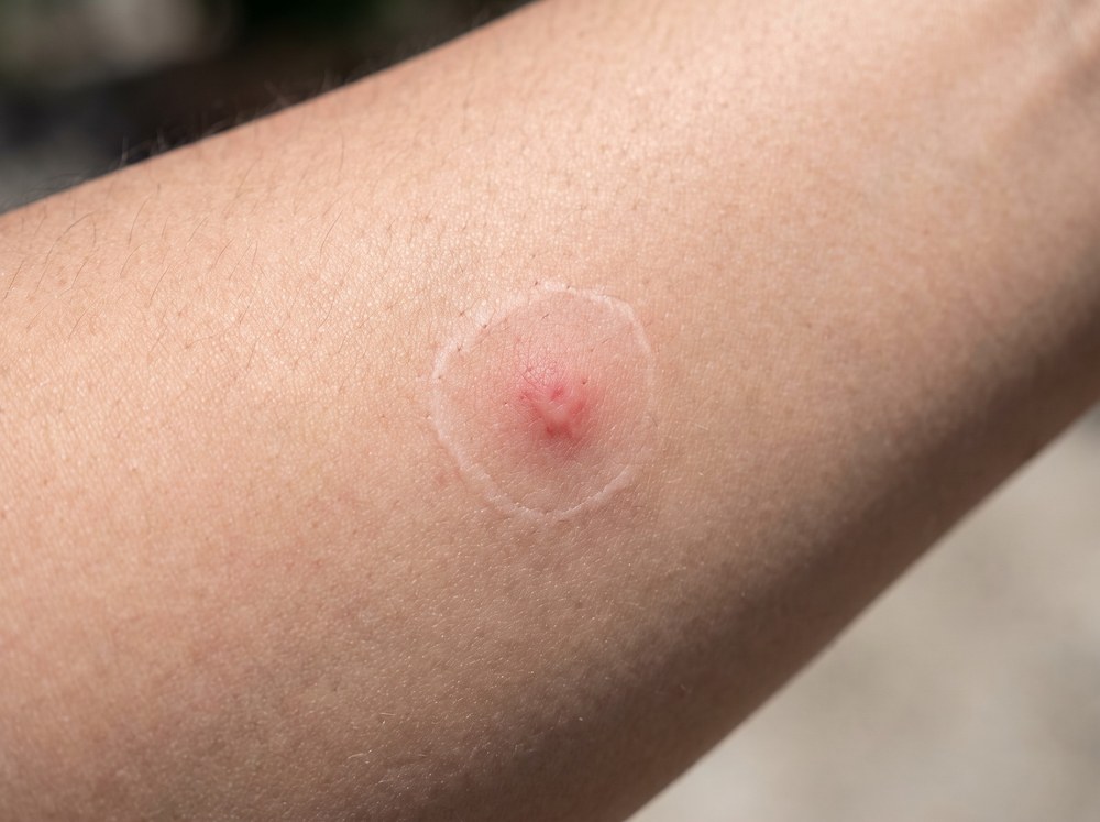 Close-up photograph of a mild house spider bite showing a small red raised bump with slight surrounding swelling and no visible pattern